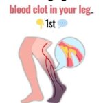 10 Warning Signs of a Blood Clot in the Leg You Should Know