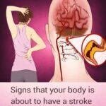 10 Early Warning Signs of a Stroke Everyone Should Know to Take Prompt Action
