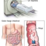 New method: colonoscopy will no longer be an invasive examination. (1/2)