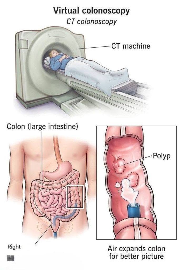 New method: colonoscopy will no longer be an invasive examination. (1/2)