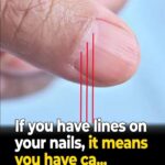 Doctor Uncovers A Telltale Sign In Your Fingernails That May Predict Your Life Expectancy