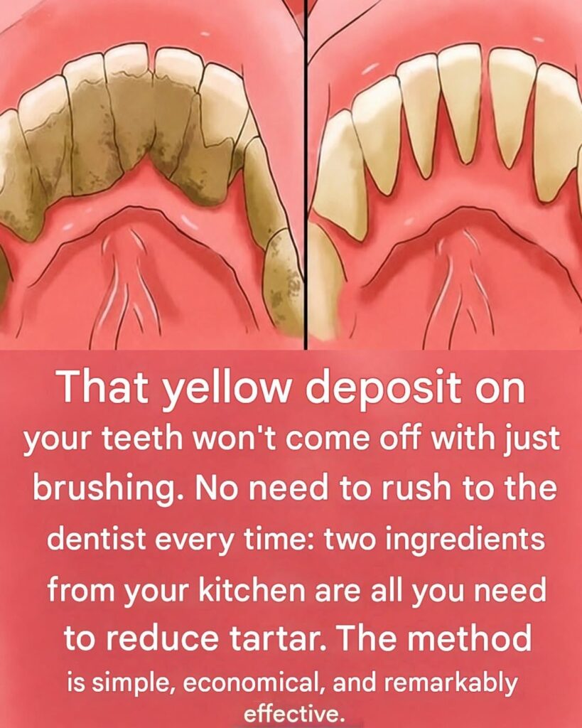 Be your own dentist! Here are some tips for removing tartar buildup at home.