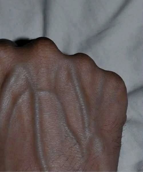 If your veins are visible in your hand, it is a signal of ca… See