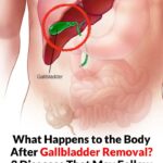 What Happens to the Body After Gallbladder Removal? 3 Diseases That May Follow – Avoid Surgery If Possible