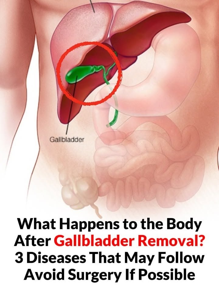 After Gallbladder Removal: 3 Conditions You Could Develop — Why You Should Avoid the Surgery When Possible