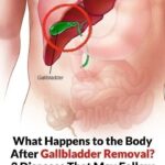 What Happens to the Body After Gallbladder Removal? 3 Diseases That May Follow – Avoid Surgery If Possible