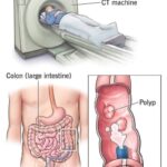 New method: colonoscopy will no longer be an invasive examination. (1/2)