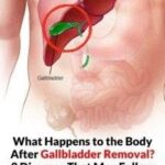 What Happens to the Body After Gallbladder Removal? 3 Diseases That May Follow – Avoid Surgery If Possible