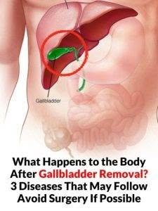 What Happens to the Body After Gallbladder Removal? 3 Diseases That May Follow – Avoid Surgery If Possible