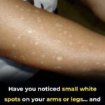 Have You Noticed Small White Spots on Your Arms or Legs? Here’s What They Are